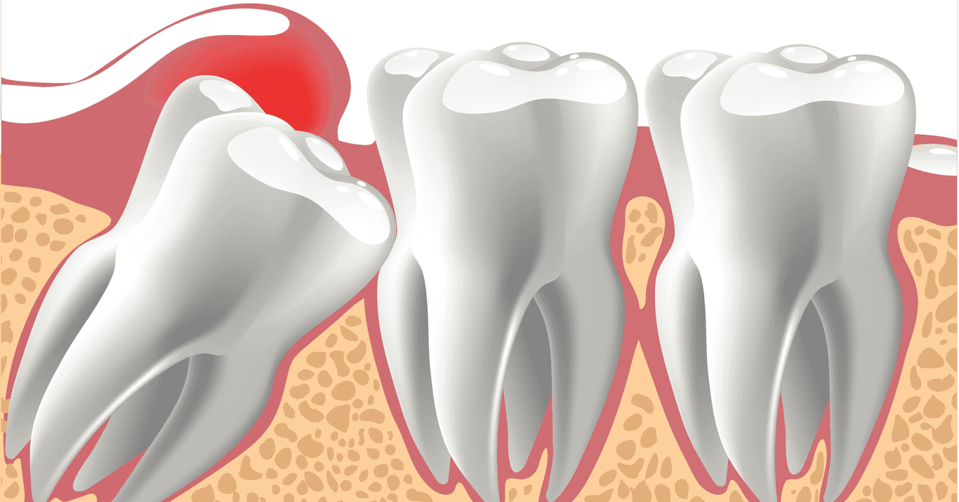 What is an Impacted Tooth? | Freytag Orthodontics